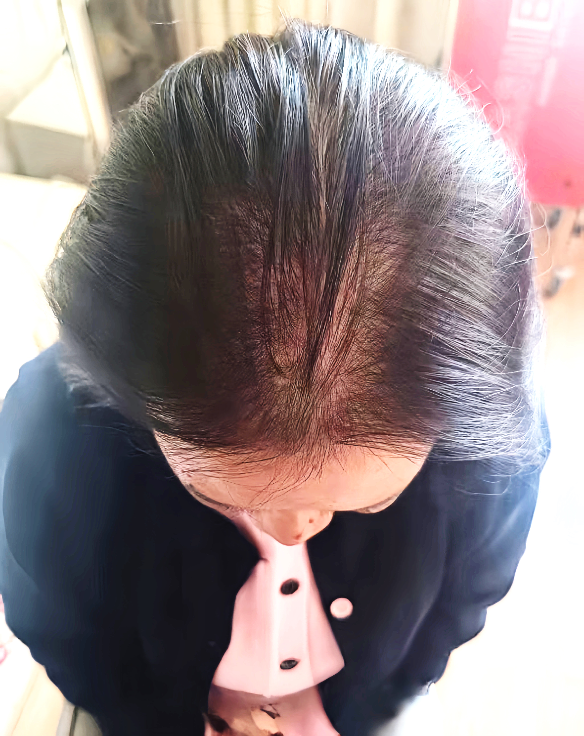 55岁女性用户8个月头顶状态记录
